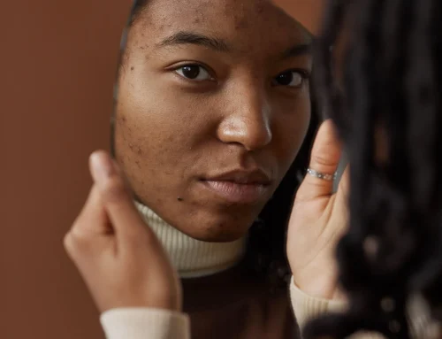 Post-inflammatory hyperpigmentation on Black and brown skin
